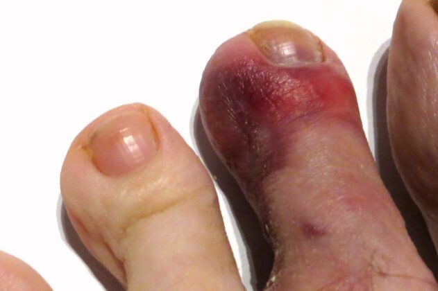 Why Do I Have A Purple Spot On My Toe